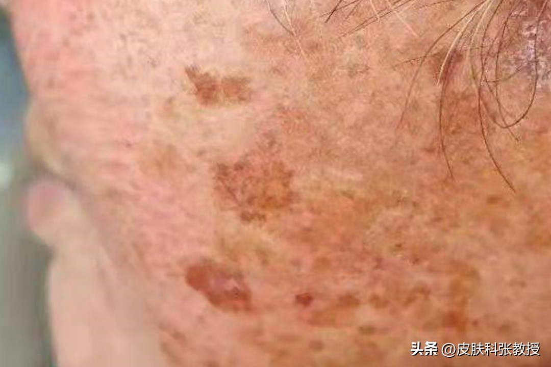 10岁女孩脸上长斑点怎么治,13岁男生脸上长褐色斑怎么治