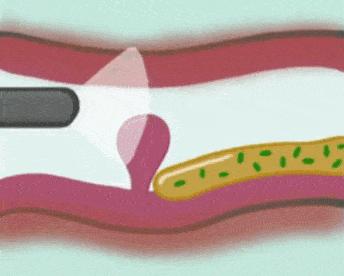 息肉一定会癌症吗,增生息肉切完会癌变吗