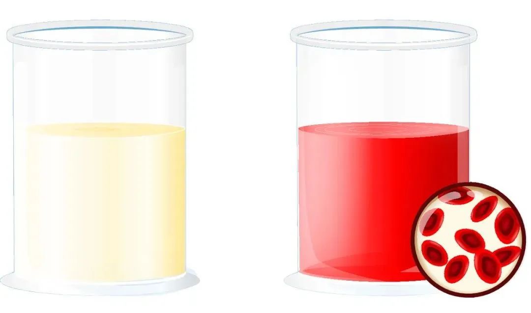 血尿是泌尿系统的警报,血尿预示着三种疾病