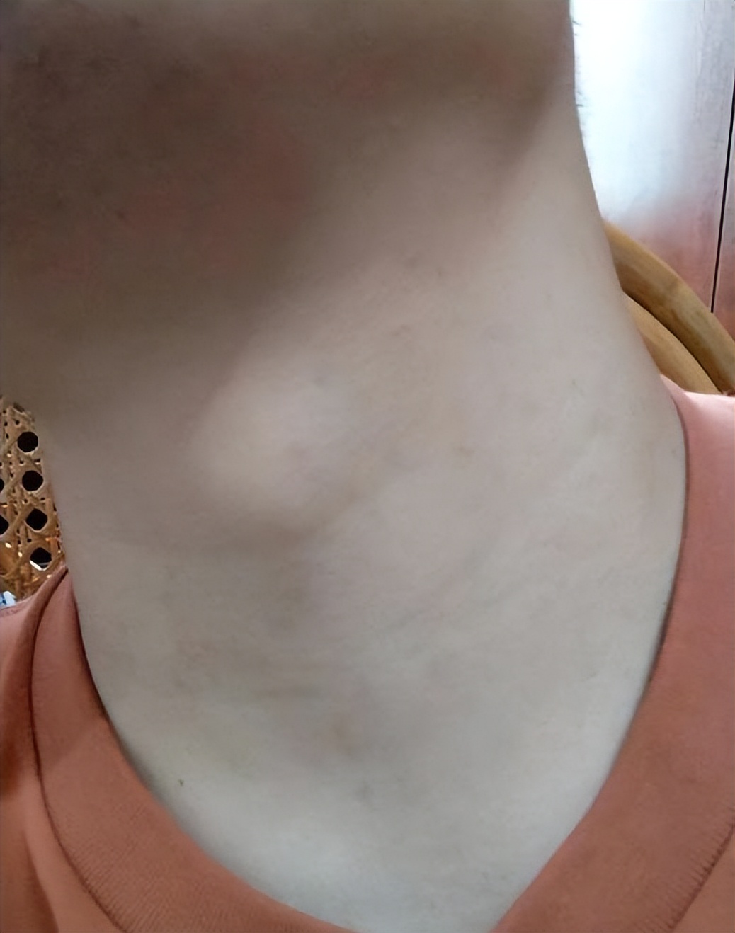 脖子上长小肉粒被自己揪掉了,脖子上的小肉粒揪掉后会怎样