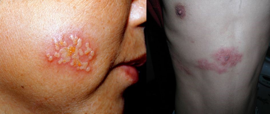 疫情期间皮肤病增多,不幸染上皮肤病怎么办