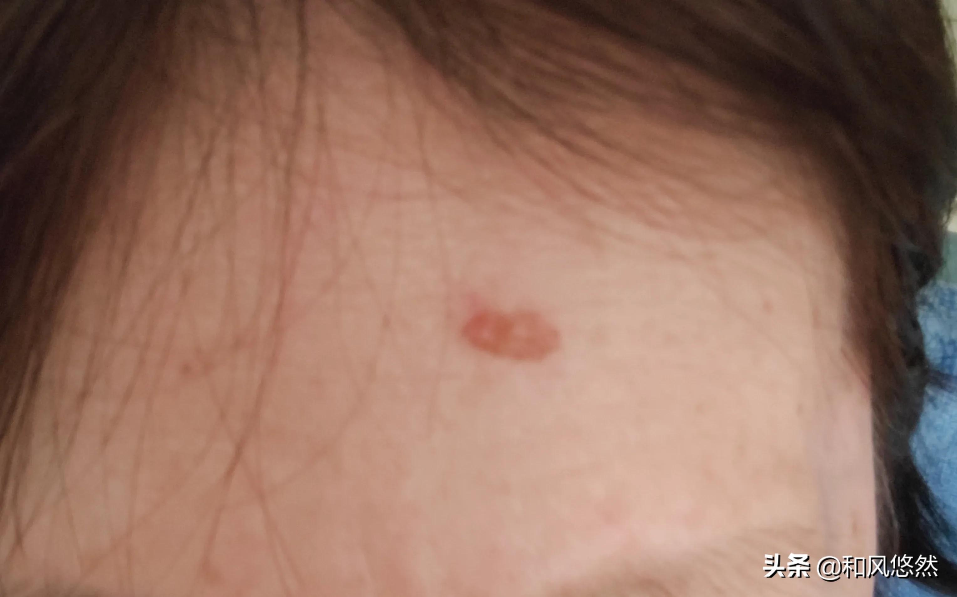 祛斑真实有效推荐,快速祛斑易出现哪些副作用