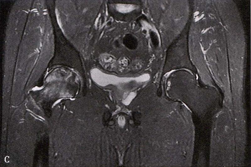 全国十大股骨头坏死诊疗中心,股骨头坏死诊疗方法有哪些