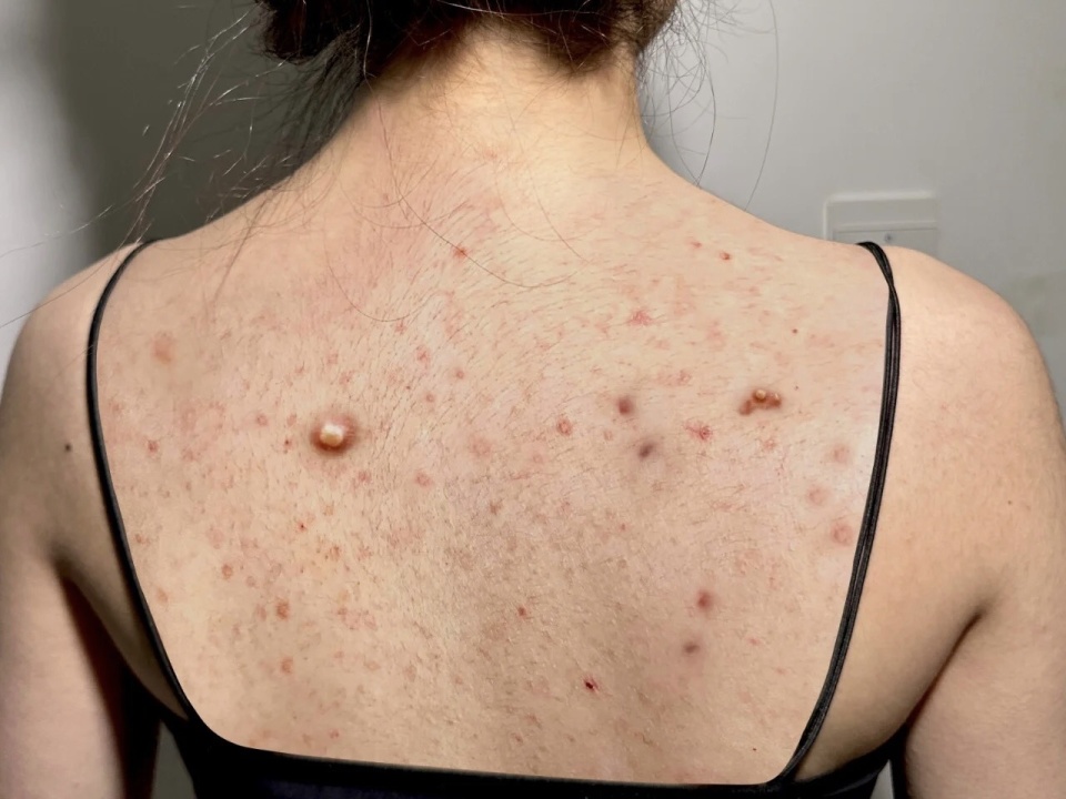 沐浴露去螨虫痘印推荐,除螨修复痘印沐浴露