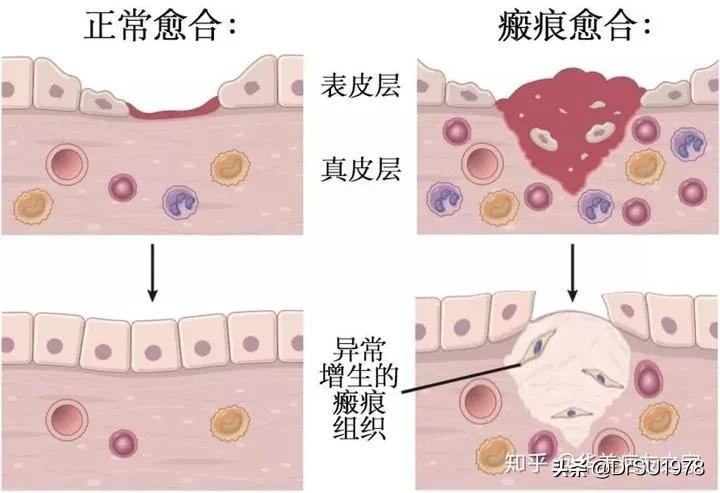 美丽怎能有瑕疵？瘢痕祛除有办法