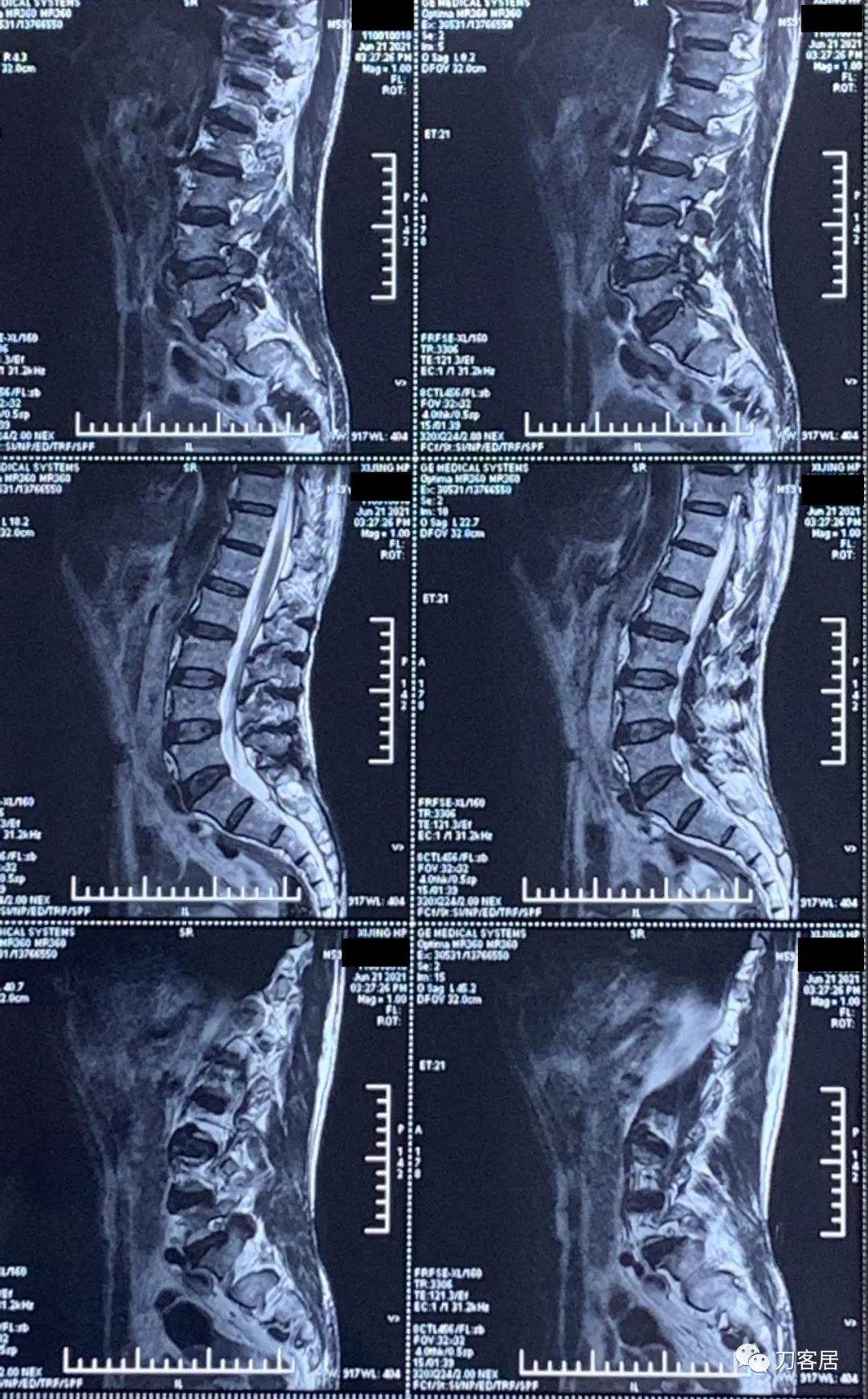 髋部疼痛小腿肌肉肿胀,髋骨疼小腿抽筋