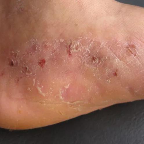 脚底疼是猝死的前兆吗,脚底脱皮是癌症的前兆