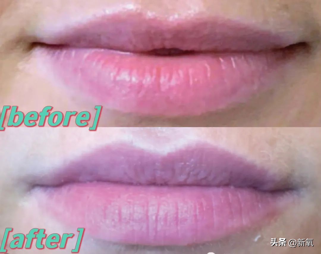 嘴唇薄变丰满,嘴唇变凸变丑怎么办