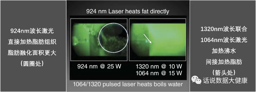激光减脂，又一个明星医美产品，效果如何？