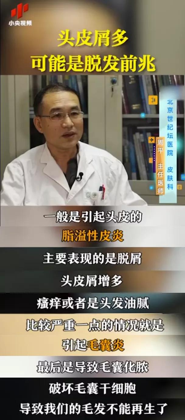 头屑多可能是脱发前兆,皮肤科医生头皮痒头屑多怎么解决