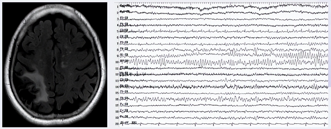 抗癫痫药,抗癫痫药物的使用原则