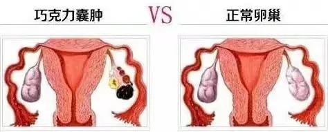 巧克力囊肿科普视频,卵巢巧克力囊肿最新治疗方法