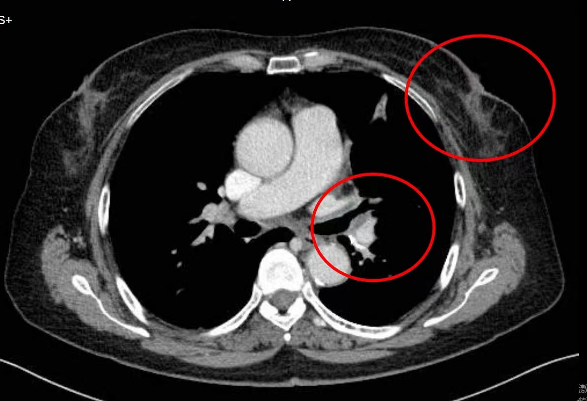 肿瘤变小但是转移了怎么办,乳腺癌术后几年肺转移有什么症状