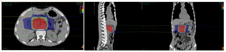 因为有你“胰”生平安——重（碳）离子治疗胰腺癌五问