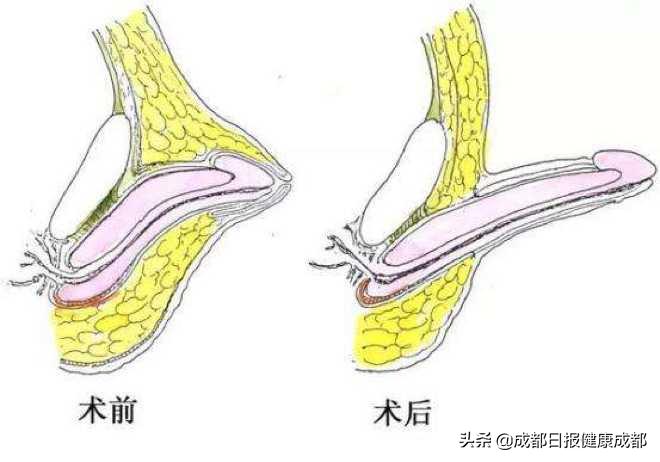 “那个”尺寸，比同龄人略逊一筹该咋办？泌尿外科专家亲自支招