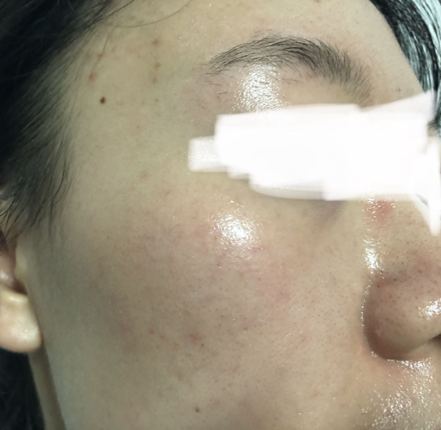 鼻头长黑粉刺怎么回事图片,鼻梁及两侧起了闭口粉刺