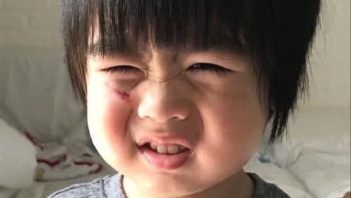 小孩身上有小红点抹啥药,孩子身上起了一个化脓性肉芽肿