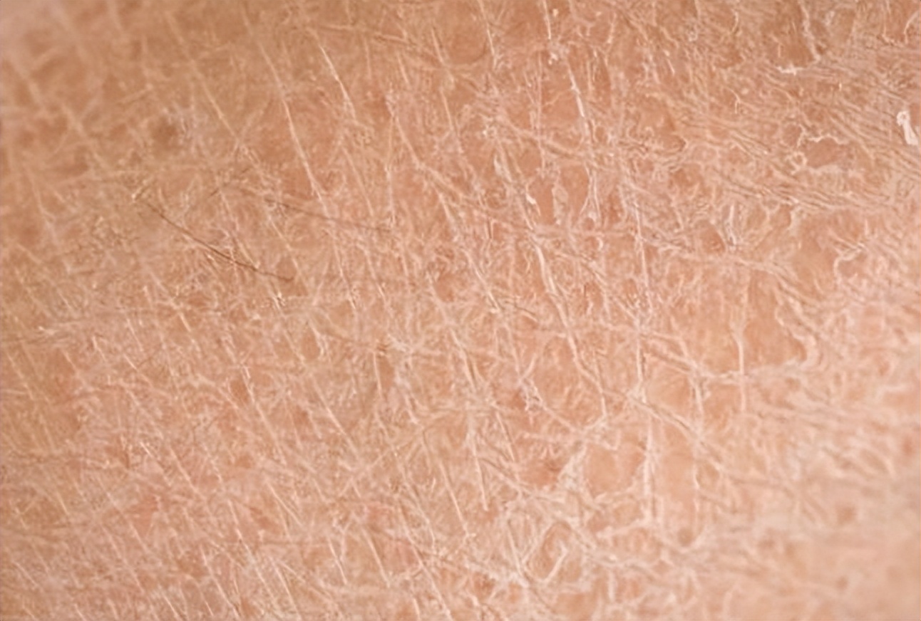 身上老是洗不干净是怎么回事,洗完澡皮肤干痒起白皮屑怎么回事