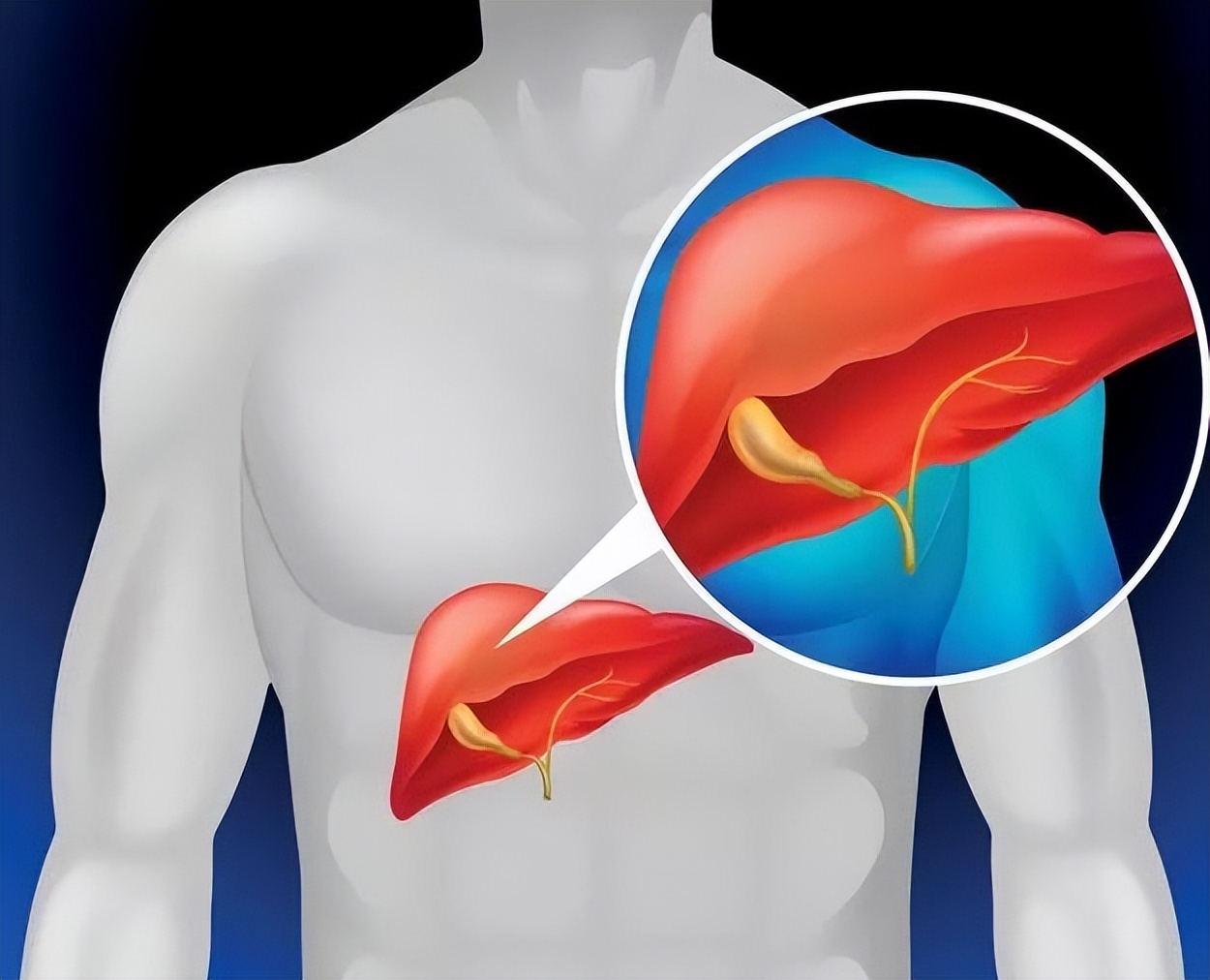什么是肝炎？如果确诊了病毒性肝炎，应该怎么办？