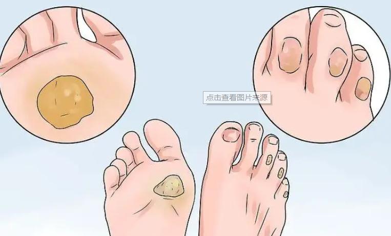 鸡眼出现的前兆,有鸡眼的人平时要注意什么