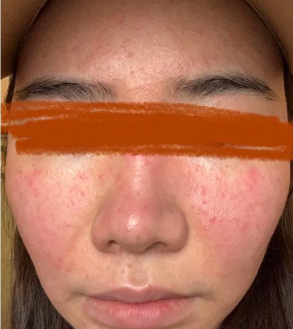 脸部皮肤又红又痒，是过敏了吗？正确的护理方法要牢记