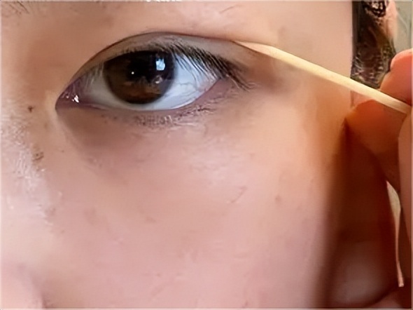 双眼皮手术后眼睛淤紫怎么消除,双眼皮术后眼头紧绷有细纹