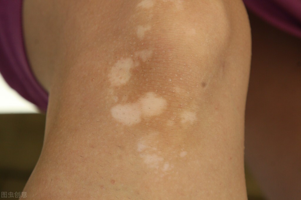 白癜风用他克莫司软膏行吗,白癜风用他克莫司使用方法