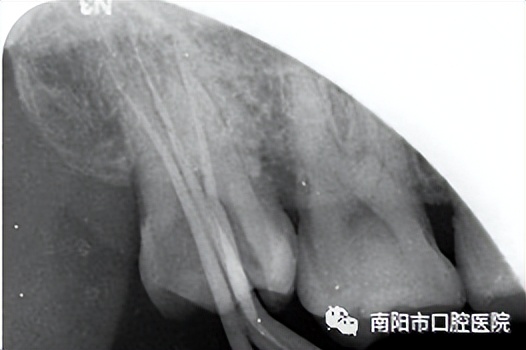 医生问你牙怎么这么不好,医生说我的牙齿裂开了怎么治疗