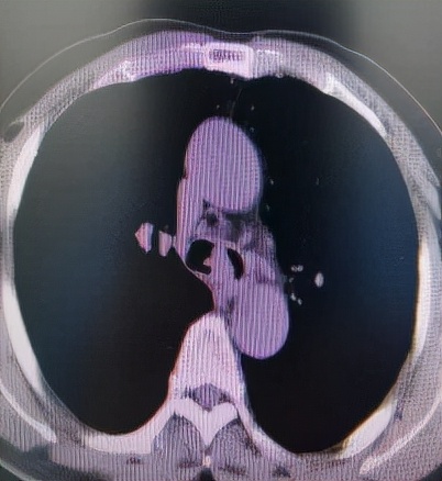 哈医大一院气管镜,哈医大群力呼吸内科