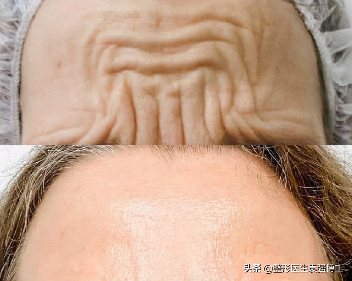 停止打玻尿酸脸会松弛下垂吗,停止打溶脂针后会怎样