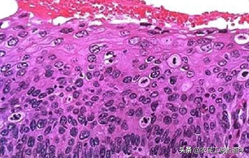 活检报告子宫颈慢性炎症,宫颈活检能查出子宫内的病吗