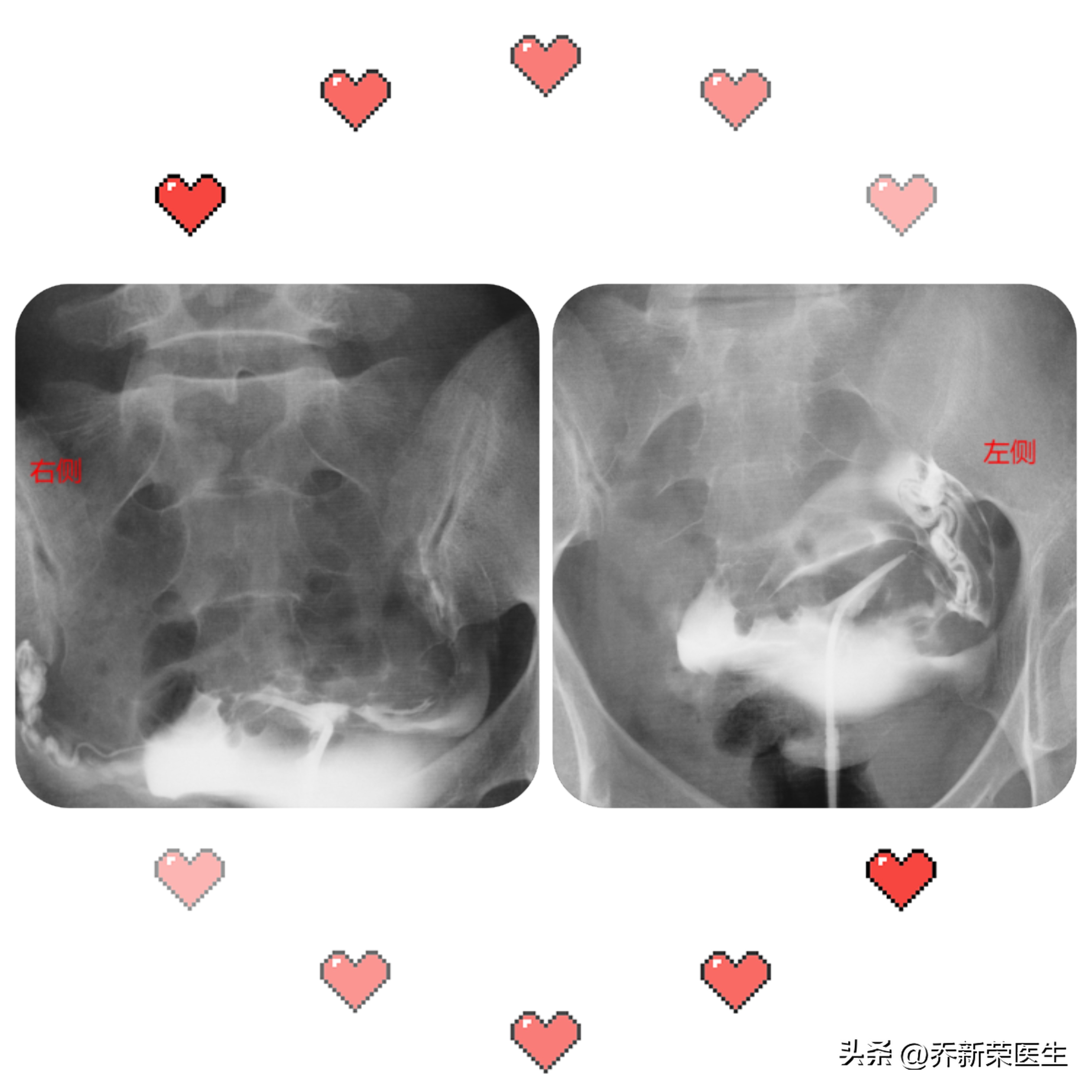 结婚十年了一直输卵管不通,结婚两年没怀孕妻子输卵管不通