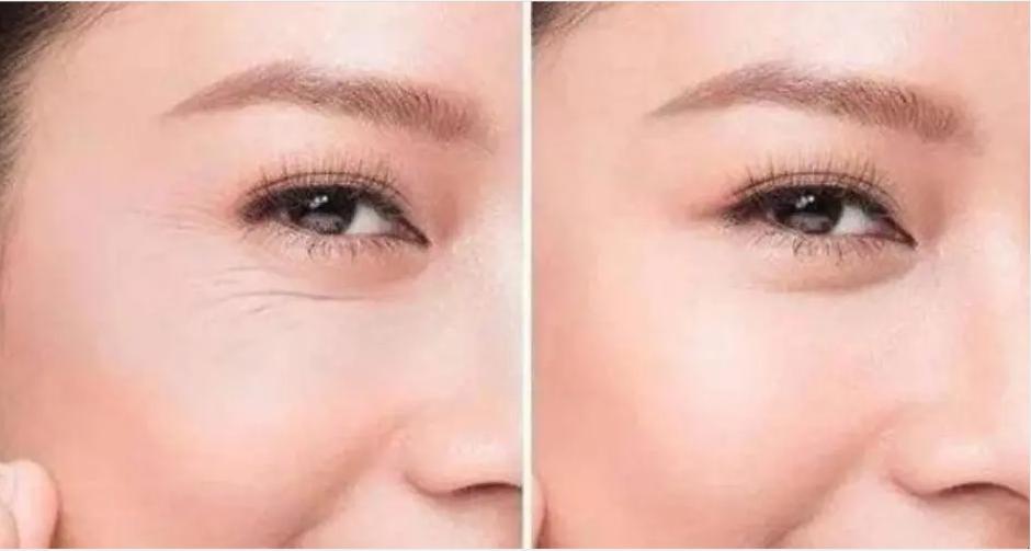 鱼尾纹是怎么引起的,什么叫鱼尾纹