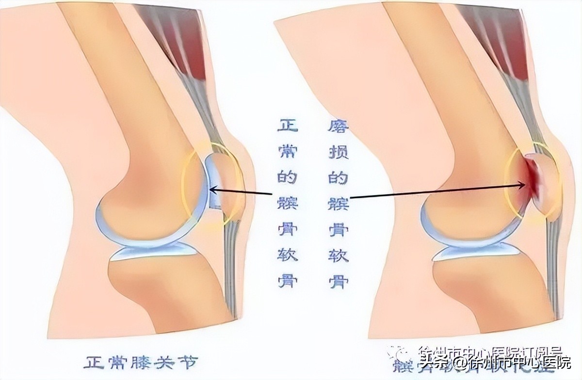 髌骨骨折六个月腿发软是什么原因,髌骨骨折术后膝盖发软是怎么回事
