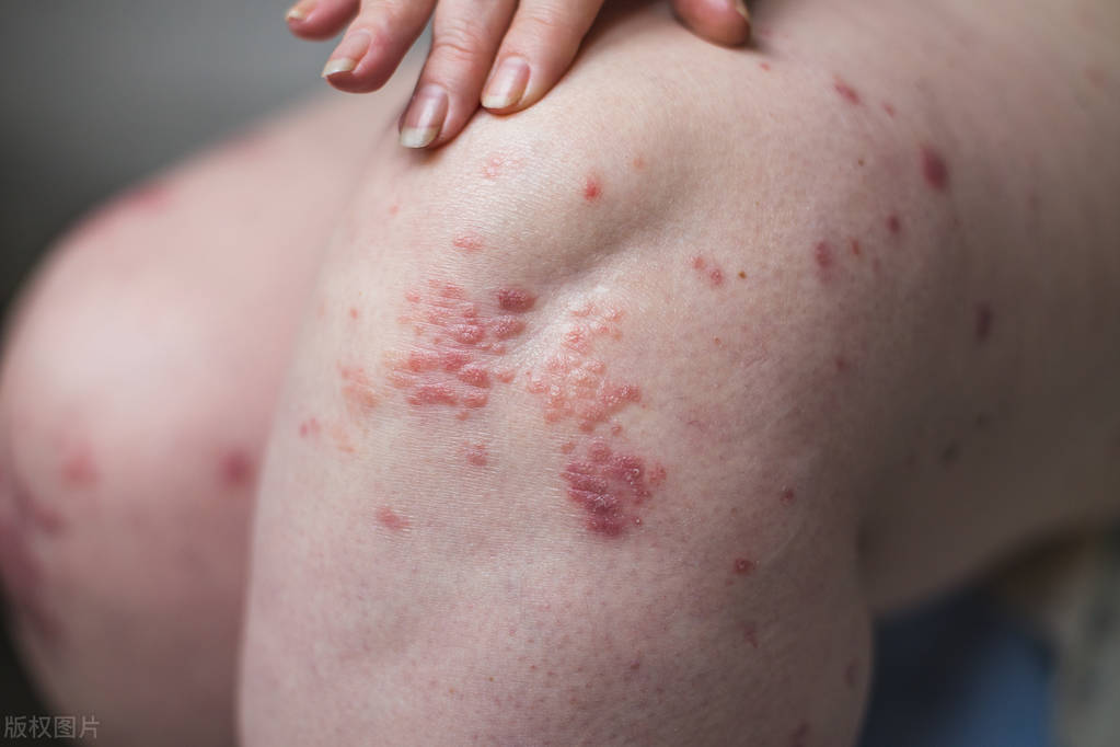 乳胶枕含有毒物质,不仅过敏还致癌?危害有多大?医生说出了真相