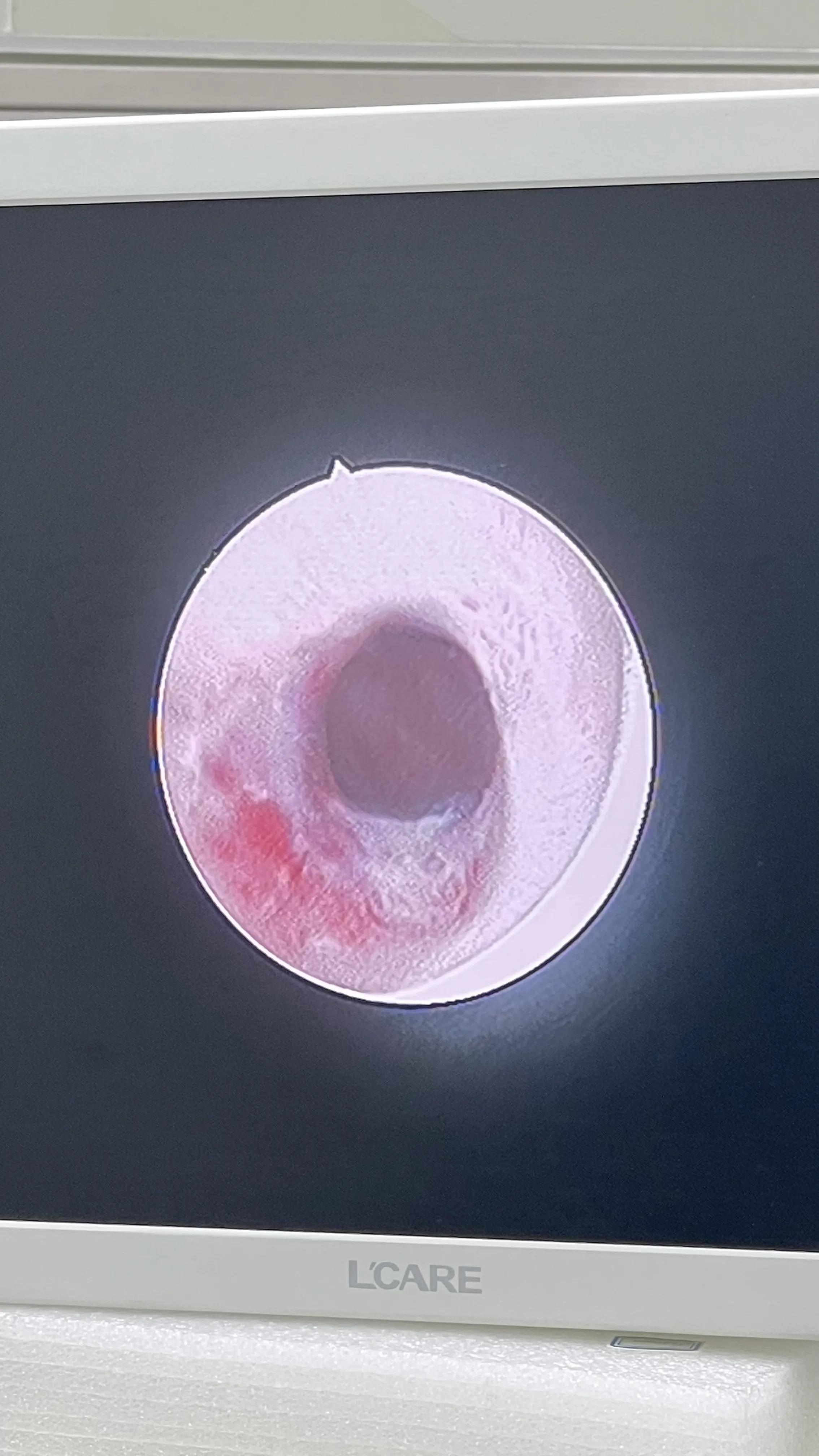 名医札记（113）“套筒穿刺导航法”治愈四川甘孜州膜部尿道闭锁