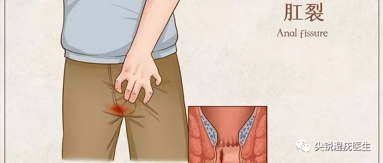 肛门周围有粉刺一样的白疙瘩,肛门周围有小疙瘩痒痒抹什么药