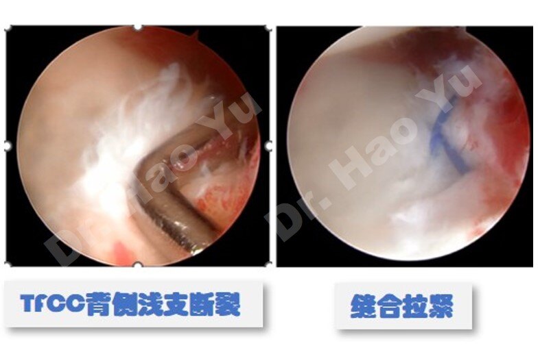 手腕三角纤维软骨复合体损伤,手腕三角软骨复合体损伤症状