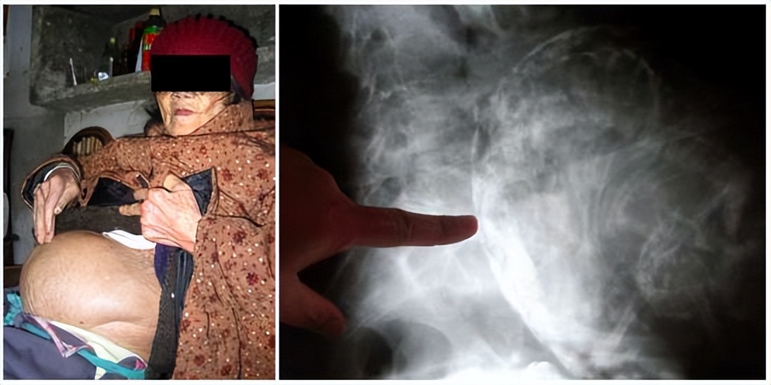 胎死腹中后孕妇有危险吗,最严重胎死腹中