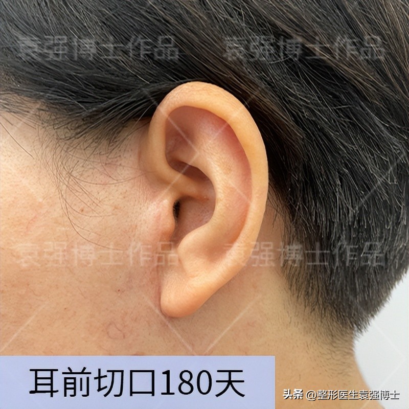 拉皮很贵吧,拉皮贵吗