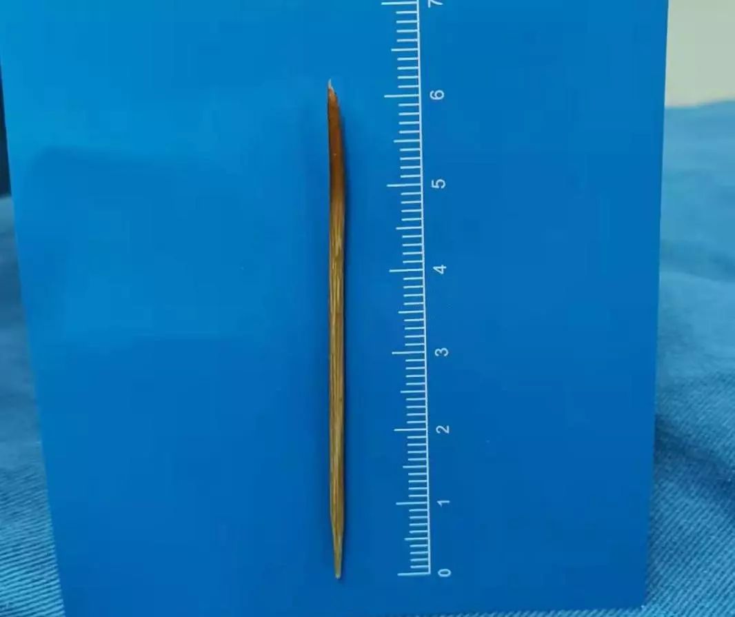 误吞牙签怎么办,少年误吞牙签一个小妙招