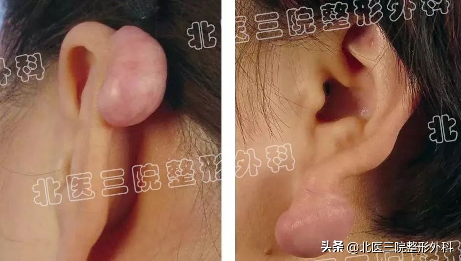 打耳洞后长出肉疙瘩做手术多少钱,打耳洞后出现疙瘩怎么办