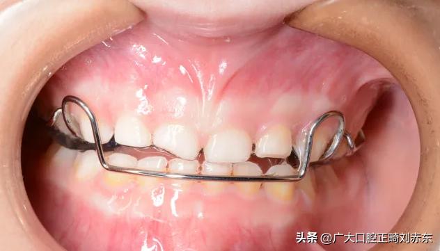 反颌属于什么病,牙反颌是什么原因