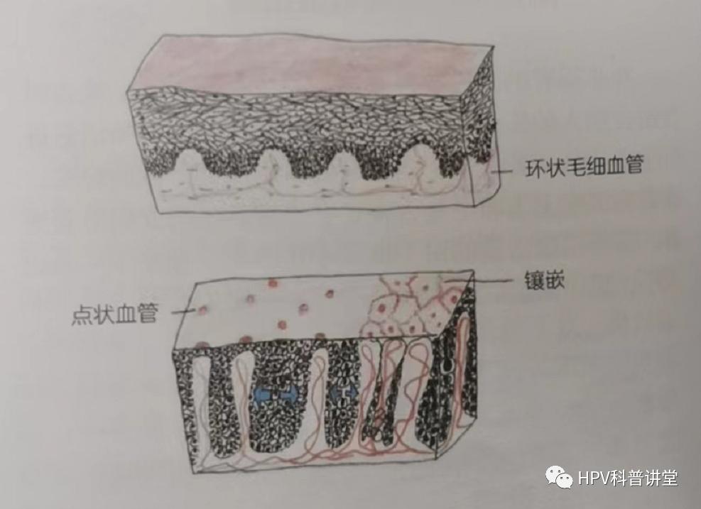 派特灵洁尔,派特灵和派特舒尔区别