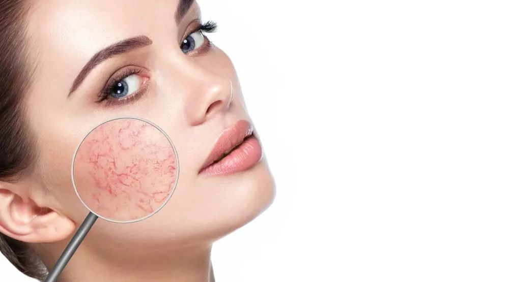 春季皮肤敏感泛红怎么修复,敏感肌肤泛红护肤步骤