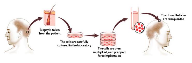 预计到2023年，头发克隆市场将达到240亿美元