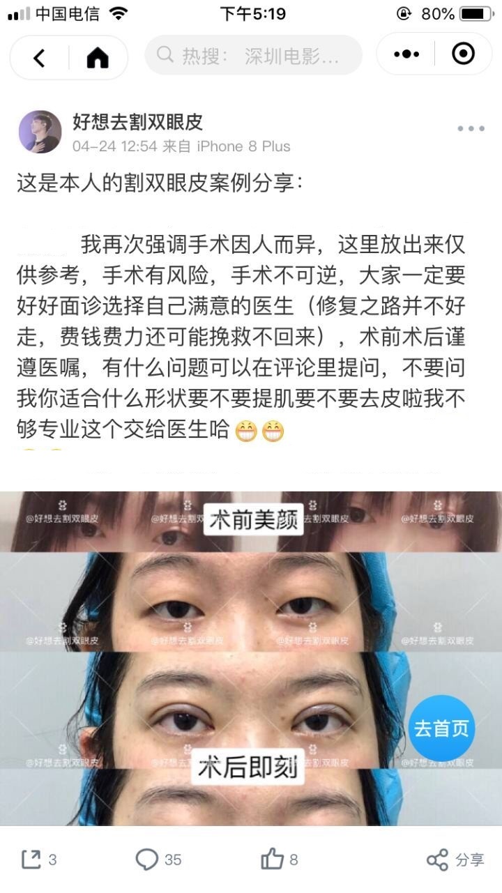 广州姑娘变美后亲述：“我的双眼皮切得很小，只有1厘米多一点”
