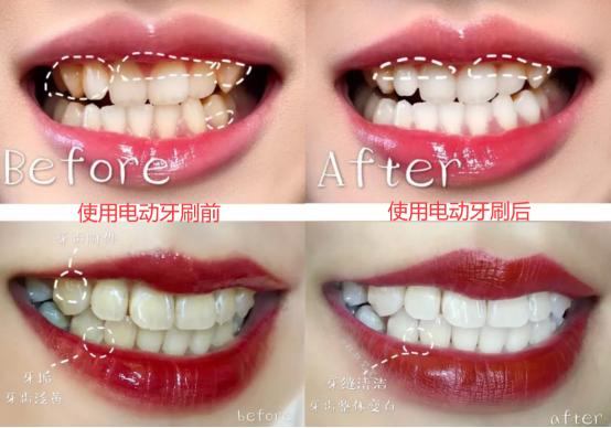 电动牙刷不伤牙,电动牙刷会伤牙吗