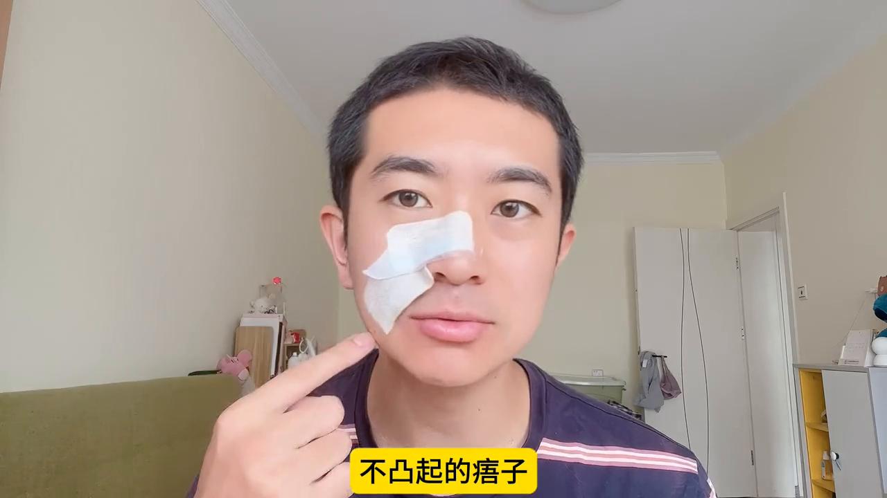 在脸上祛痣打麻药痛吗,脸上祛痣激光还是液氮