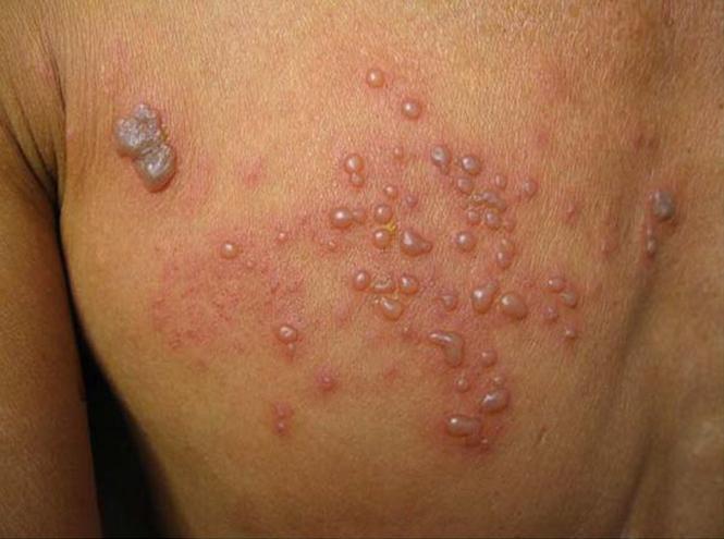 夫妻性传播疾病有哪些,得了性传播有哪些症状